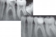 آیا پر کردن دندان خیلی پوسیده بدون عصب کشی ممکن است؟